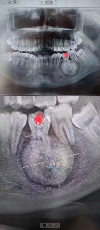 拔牙拔出肿瘤图片
