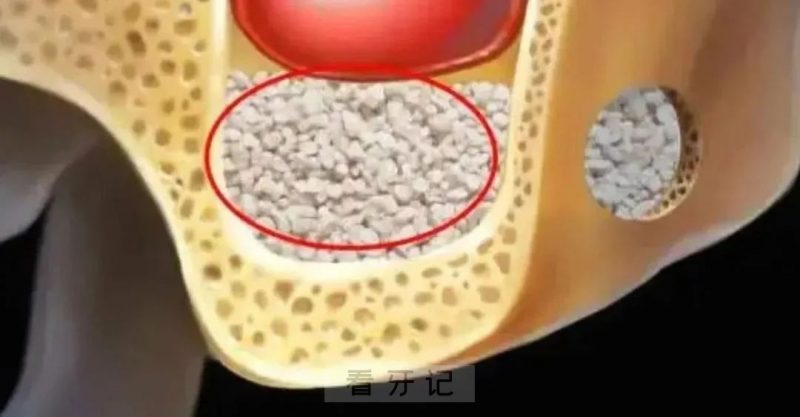 种植牙骨粉填充植骨后悔死了