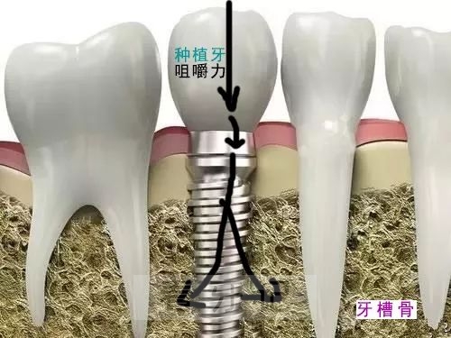 良心牙医告诉你老年人该选烤瓷牙还是选种植牙