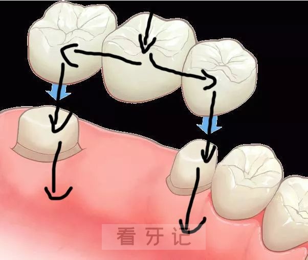 良心牙医告诉你老年人该选烤瓷牙还是选种植牙