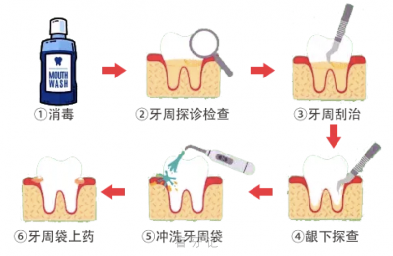 洗牙和牙周刮治有什么具体区别？