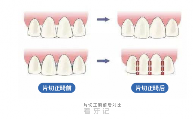 小孩子做矫正不拔牙还有别的办法吗？