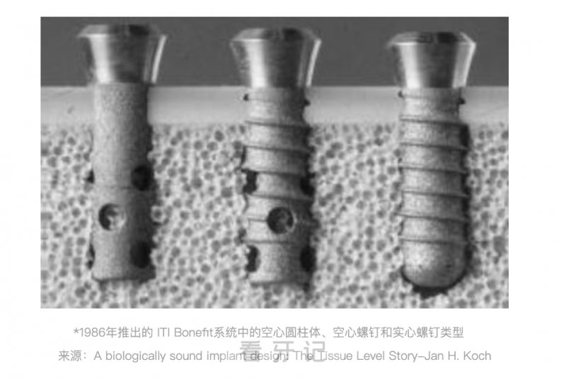 ITI种植牙和士卓曼种植牙有什么区别？