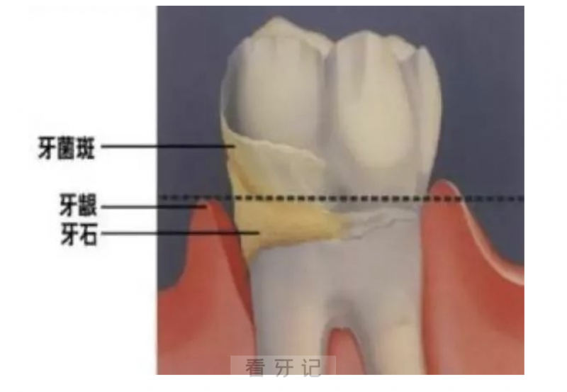 什么是龈下结石？牙结石长在牙龈下面怎么办？