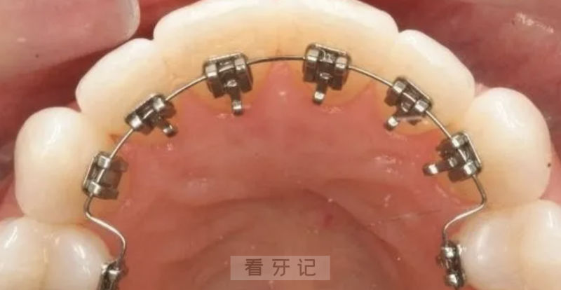 国内牙科矫正牙套价格多少钱？附2024最新矫正价格表