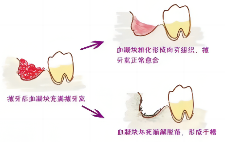 如何判断自己得了干槽症？剧痛是不是干槽症？