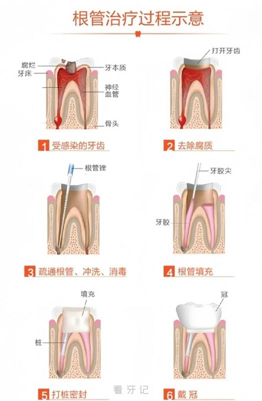 根管治疗和补牙哪个更疼？哪个更麻烦？