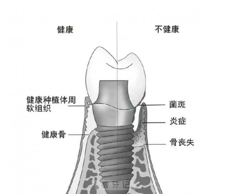 种植牙后遗症：种植体周围炎症状