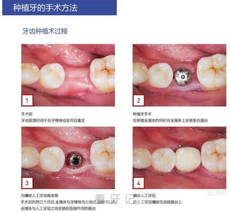 种植牙过程真实图片