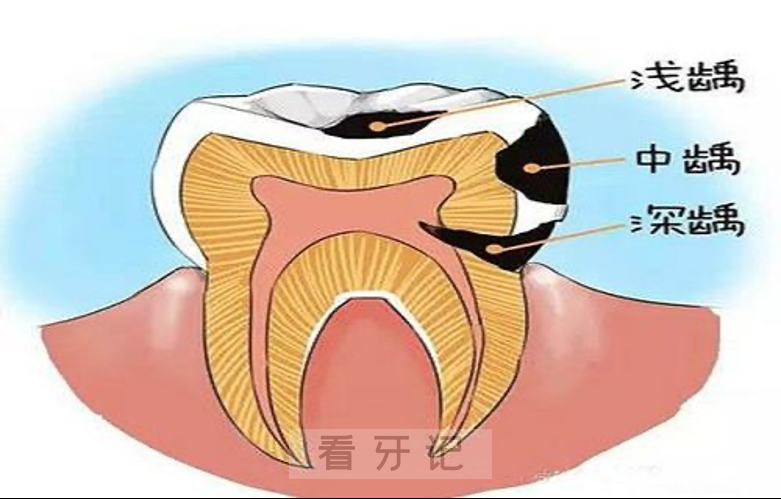 什么是龋齿？有哪些症状？