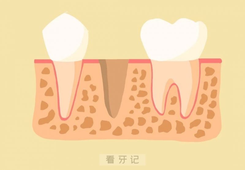 种植牙完整步骤图片