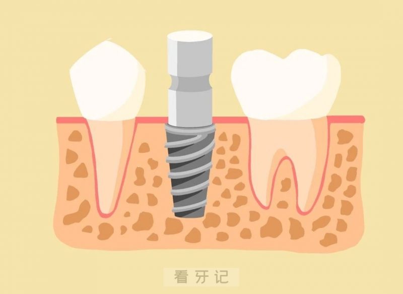 种植牙完整步骤图片