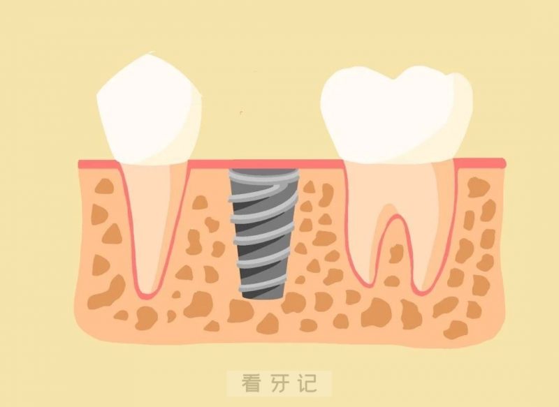 种植牙完整步骤图片