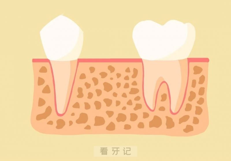 种植牙完整步骤图片