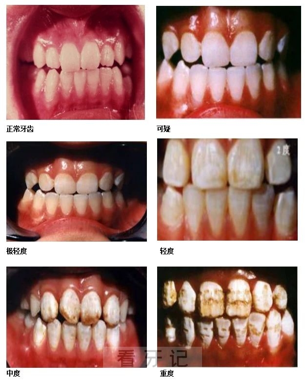 氟斑牙严重程度等级照片（正常、极轻、轻度、中度、重度）