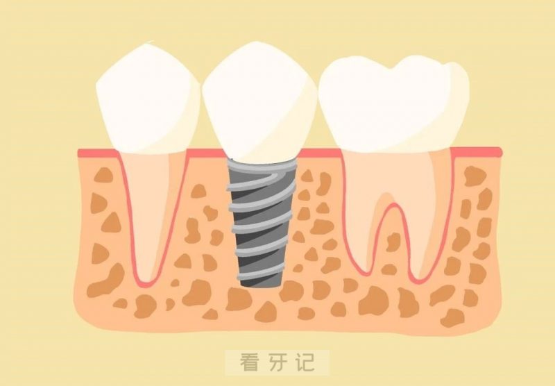 种植牙的基本组成