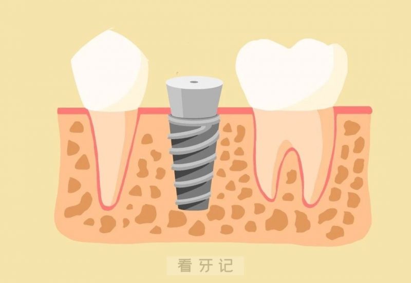 种植牙完整步骤图片