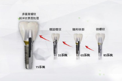 024韩国奥齿泰种植牙多少钱一颗？参考价格3500+"