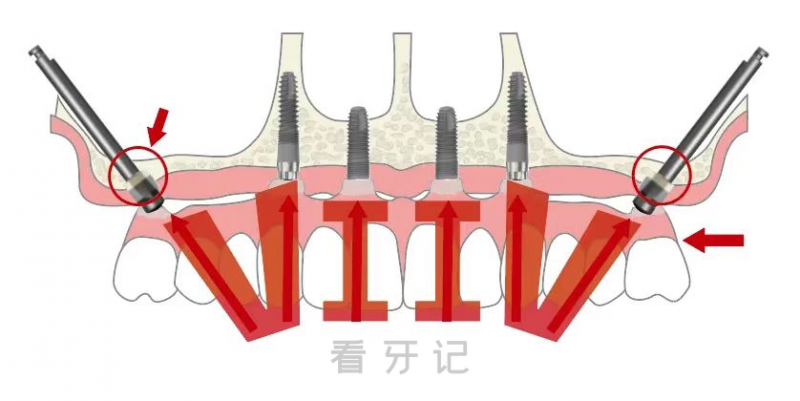 VIIV疑难种牙技术介绍