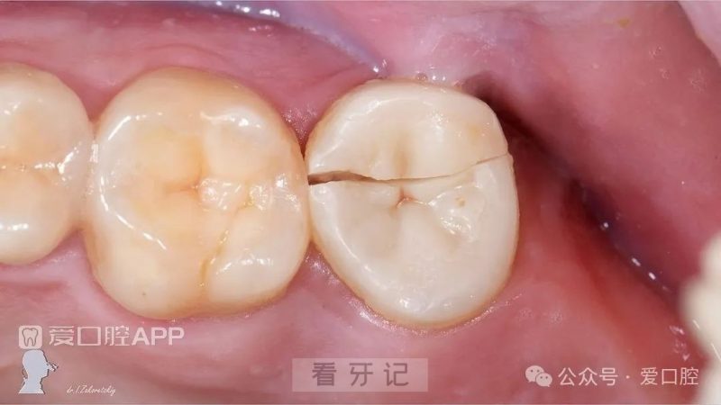 严重牙隐裂真实图片对比