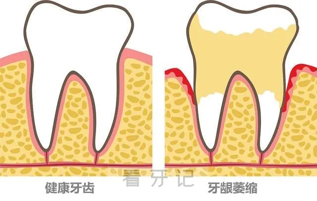 牙龈萎缩还能长回来吗？是不是不可逆转？