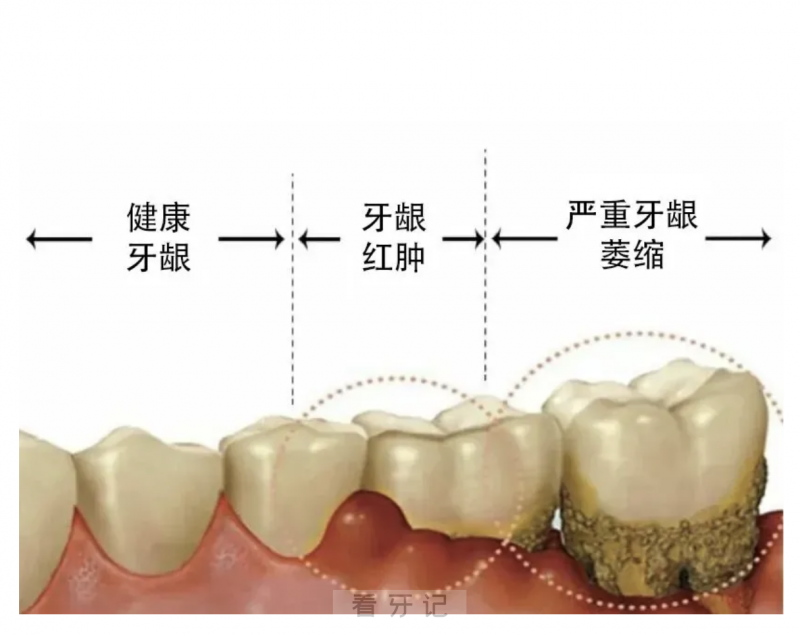 牙龈萎缩是绝症吗？无法治愈吗？牙龈萎缩真实对比图