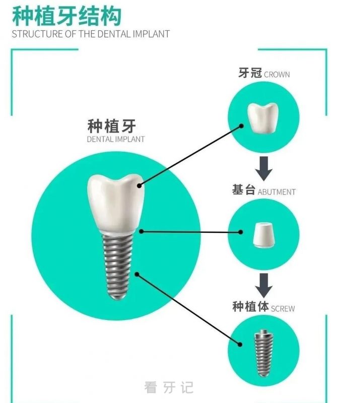 千万别种牙？种植牙是智商税？附种植牙结构图