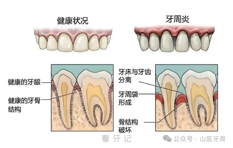 牙周炎的牙和健康的牙区别有哪些？附照片对比图